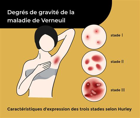 verneuil's disease clinro